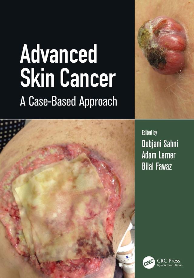 Advanced Skin Cancer by Adam Lerner, Debjani Sahni