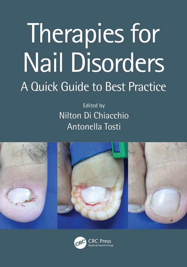 Therapies for Nail Disorders by Antonella Tosti, Nilton Di Chiacchio
