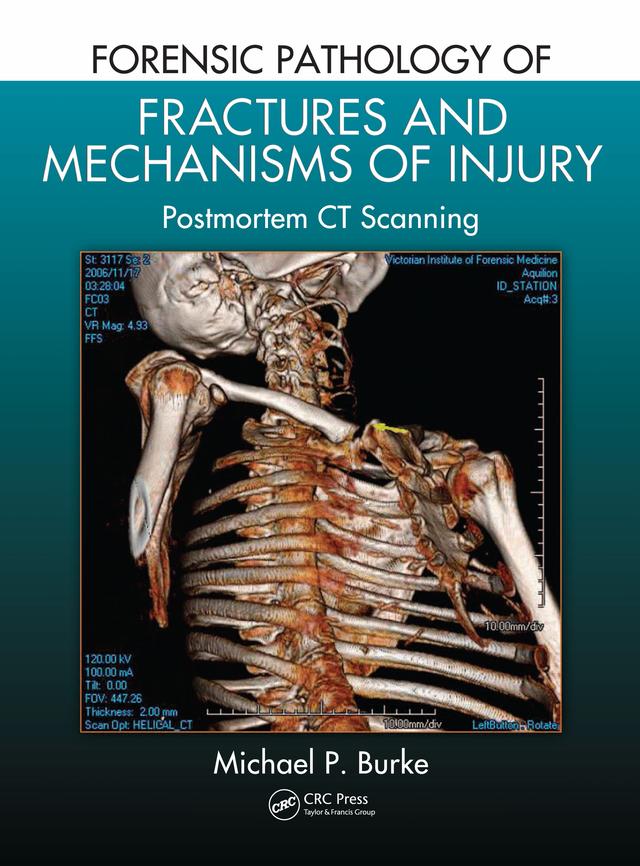 Forensic Pathology of Fractures and Mechanisms of Injury by Michael P. Burke