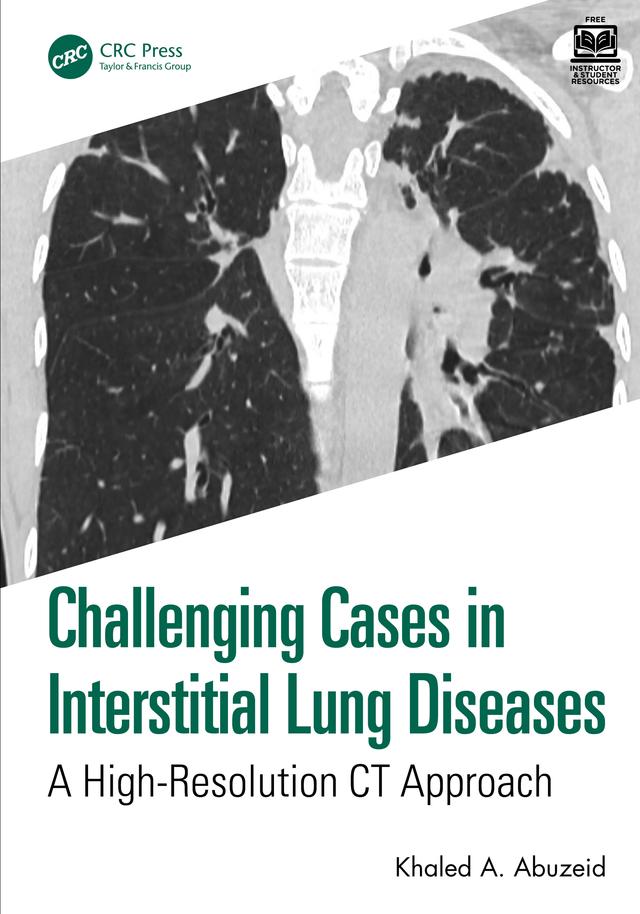 Challenging Cases in Interstitial Lung Diseases by Khaled A. Abuzeid