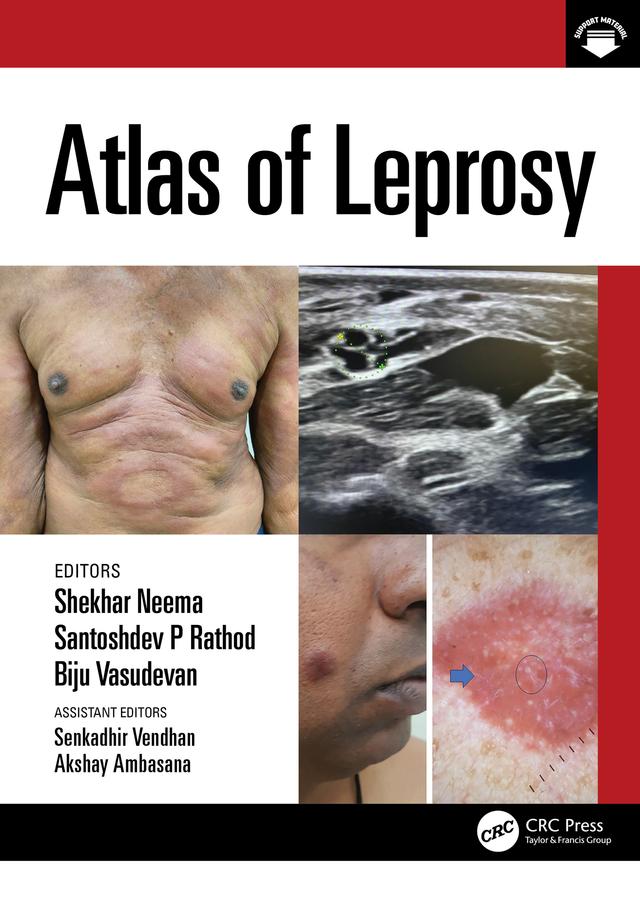 Atlas of Leprosy by Biju Vasudevan, Santoshdev Rathod, Shekhar Neema