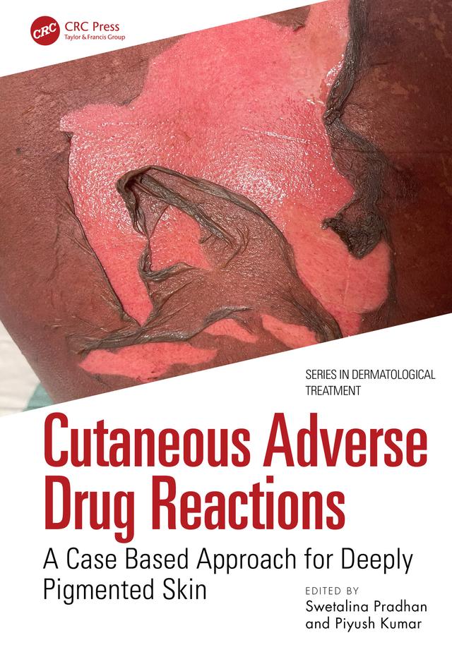 Cutaneous Adverse Drug Reactions by Piyush Kumar, Swetalina Pradhan