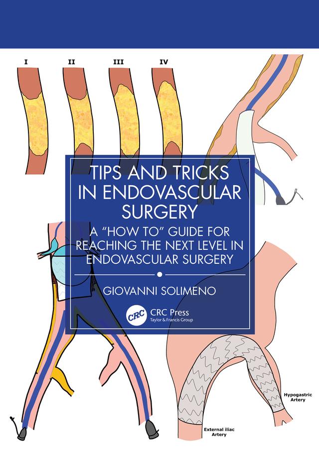 Tips and Tricks in Endovascular Surgery by Giovanni Solimeno