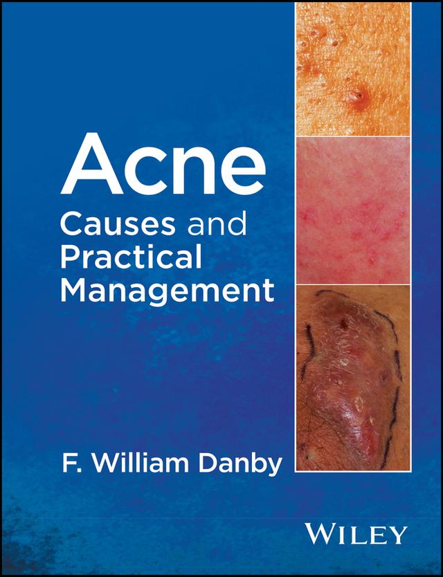 Acne by F. William Danby