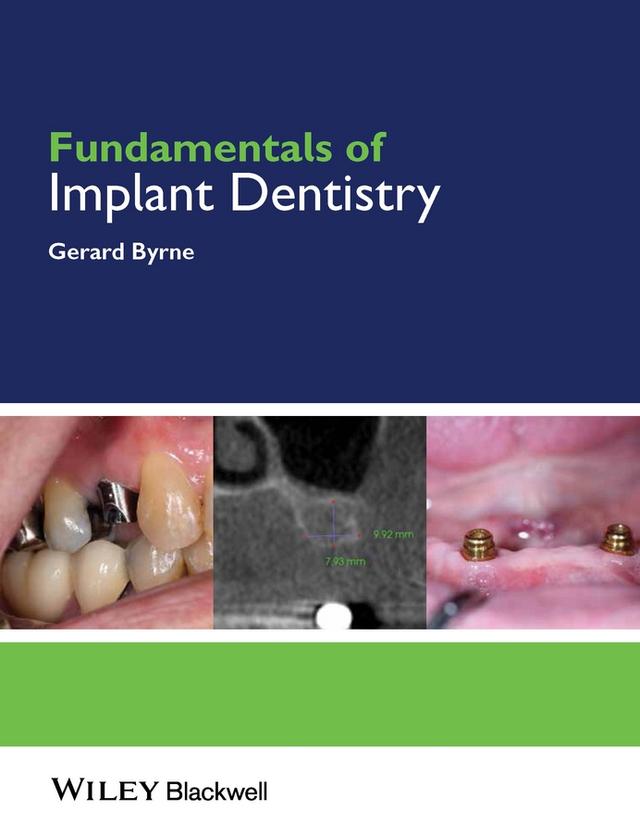 Fundamentals of Implant Dentistry by Gerard Byrne
