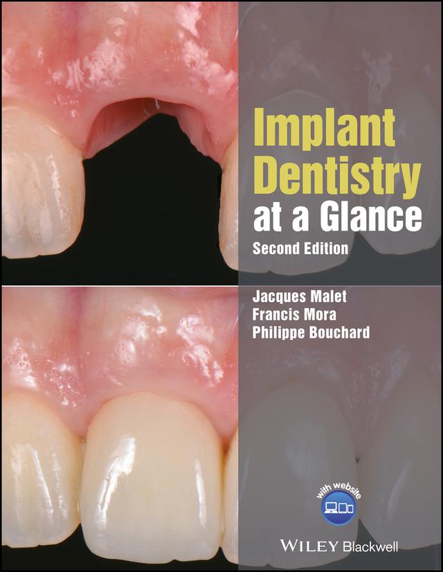 Implant Dentistry at a Glance by Francis Mora, Jacques Malet, Philippe Bouchard