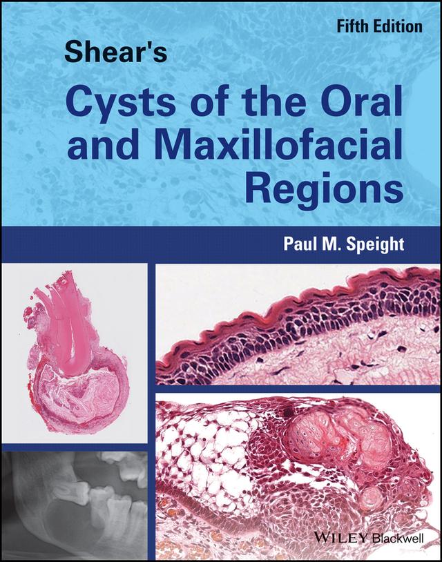Shear's Cysts of the Oral and Maxillofacial Regions by Paul M. Speight