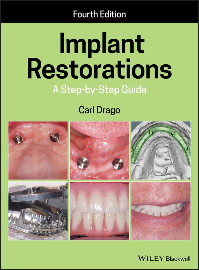 Implant Restorations by Carl Drago