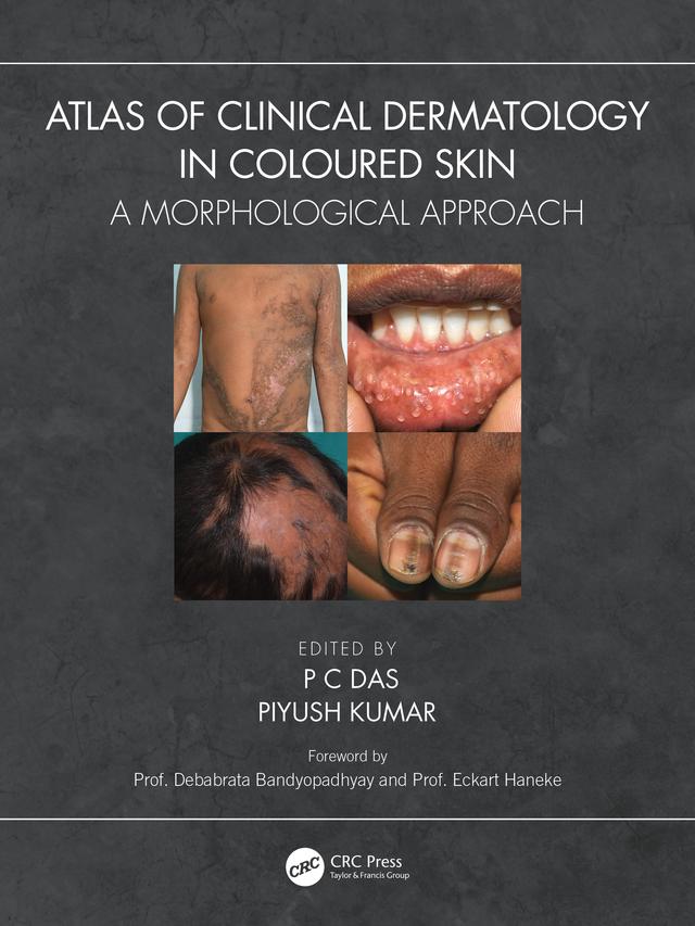 Atlas of Clinical Dermatology in Coloured Skin by P C Das, Piyush Kumar