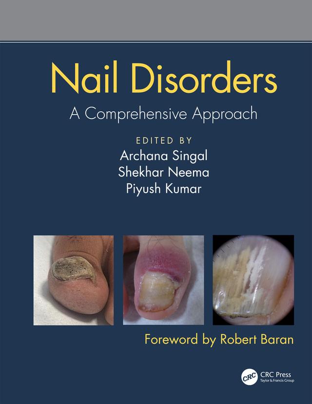 Nail Disorders by Archana Singal, Piyush Kumar, Shekhar Neema