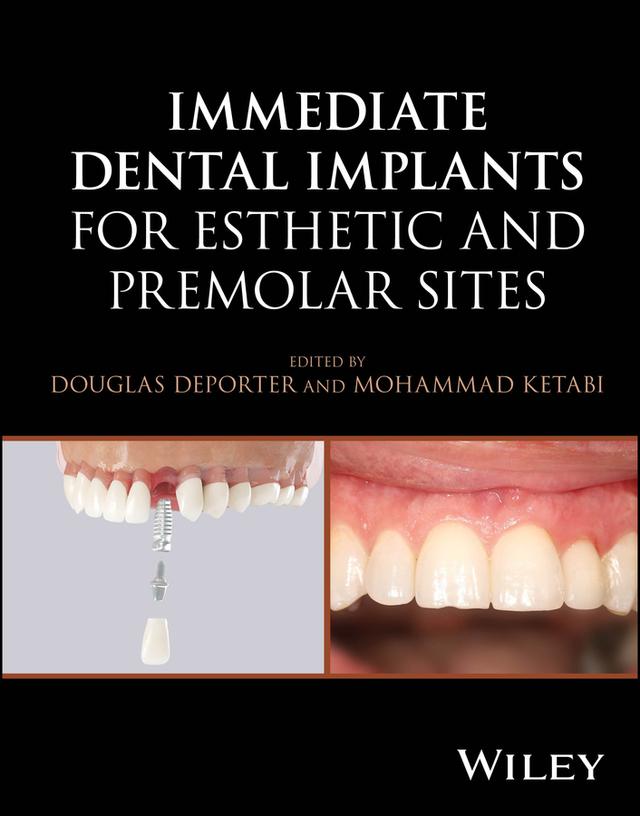 Immediate Dental Implants for Esthetic and Premolar Sites by Douglas Deporter, Mohammad Ketabi