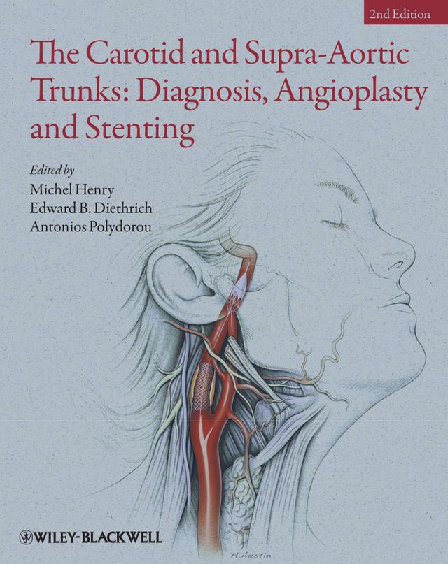The Carotid and Supra-Aortic Trunks by Antonios Polydorou, Edward B. Diethrich, Michel Henry