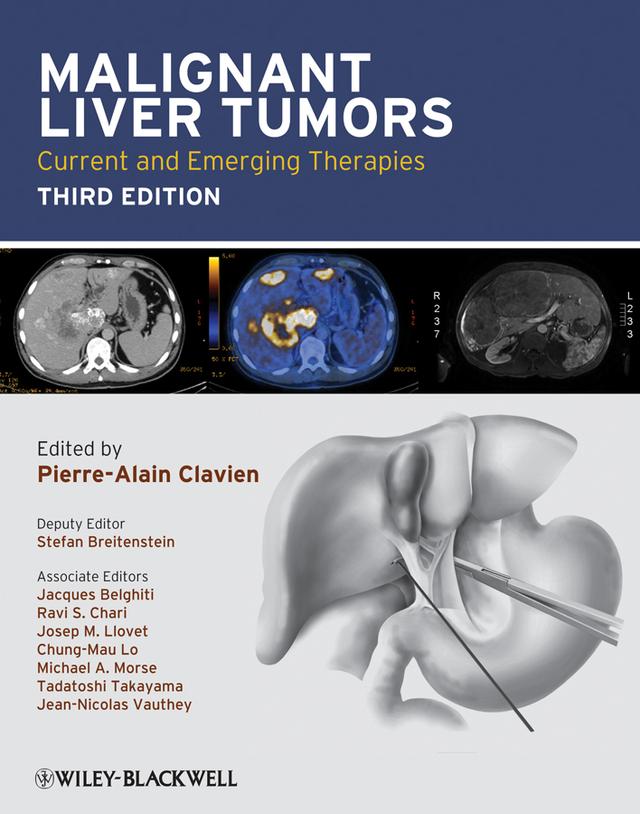 Malignant Liver Tumors by Chung-Mau Lo, Jacques Belghiti, Jean-Nicolas Vauthey, Josep M. Llovet, Michael A. Morse, Pierre-Alain Clavien, Ravi S. Chari, Stefan Breitenstein, Tadatoshi Takayama