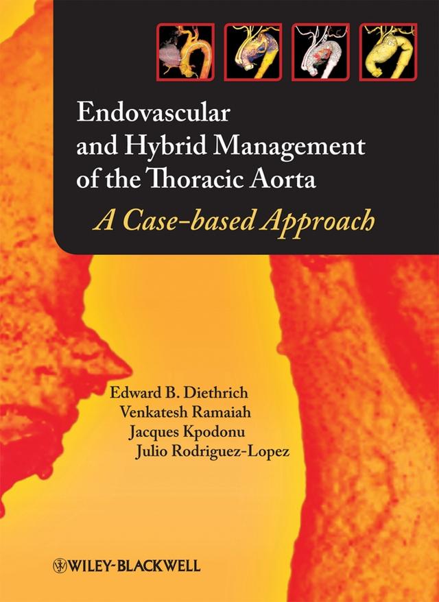 Endovascular and Hybrid Management of the Thoracic Aorta by Edward B. Diethrich, Jacques Kpodonu, Julio A. Rodriguez-Lopez, Venkatesh Ramaiah