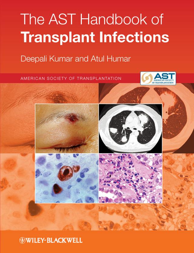 The AST Handbook of Transplant Infections by Atul Humar, Deepali Kumar
