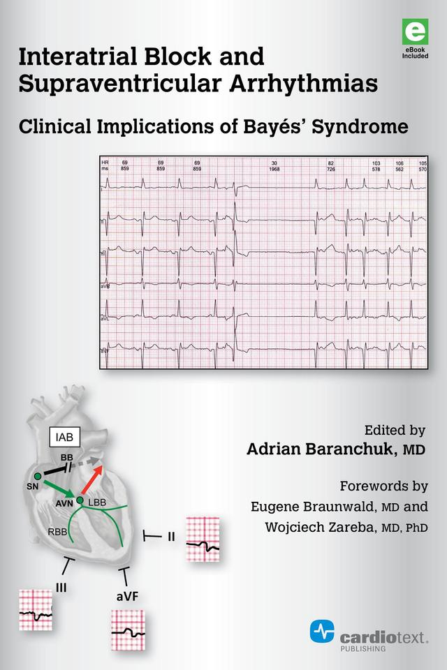 Interatrial Block and Supraventricular Arrhythmias: Clinical Implications of Bayés Syndrome by Adrian Baranchuk