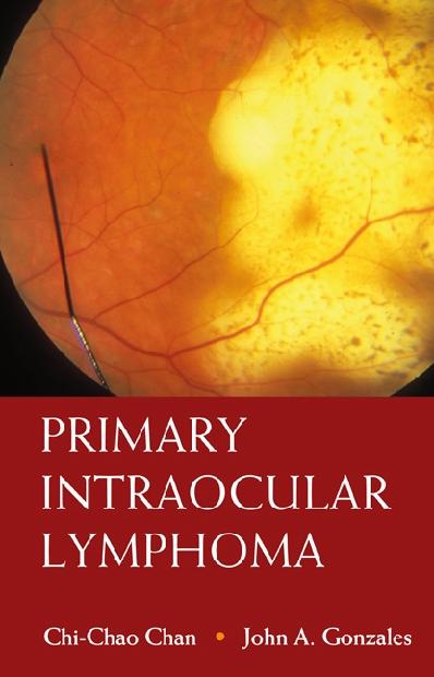 PRIMARY INTRAOCULAR LYMPHOMA by Chan Chi-chao, Gonzales John A